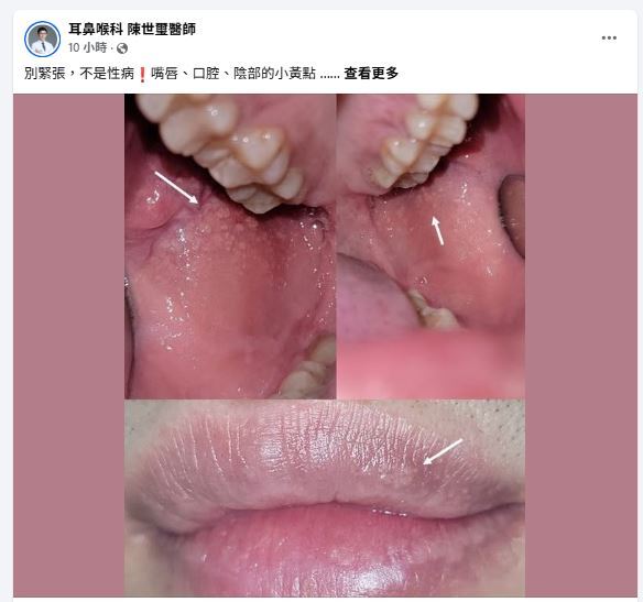 陳世璽醫師在臉書粉專解釋什麼是「福代斯斑點」。（圖／翻攝自臉書粉專「耳鼻喉科 陳世璽醫師」）