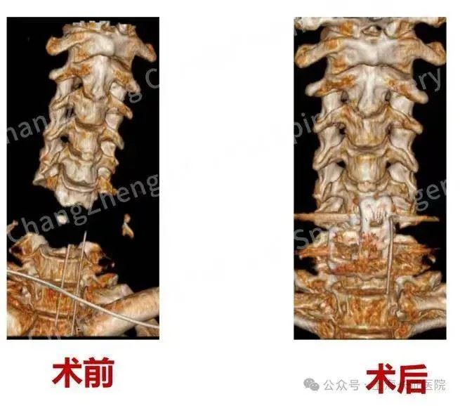 院方用3D展示術前和術後頸椎修復的狀況。(圖/翻攝微博)