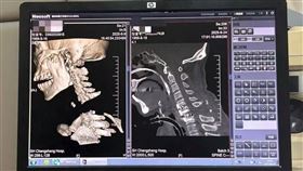 患者頸椎大跨度脫位如「身首離斷」，上海醫師3小時成功復位。(圖/翻攝微博)