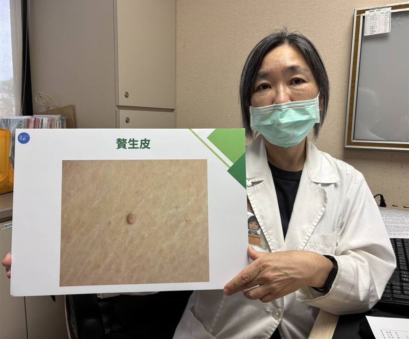 有患者贅生皮經摩擦導致皮膚破損，進而傷口發炎。（圖／書田診所提供）