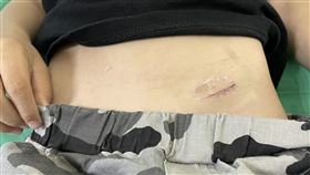 5歲男童，肚子痛，兒童腹股溝疝氣，睪丸腫塊(圖／烏日林新醫院提供)