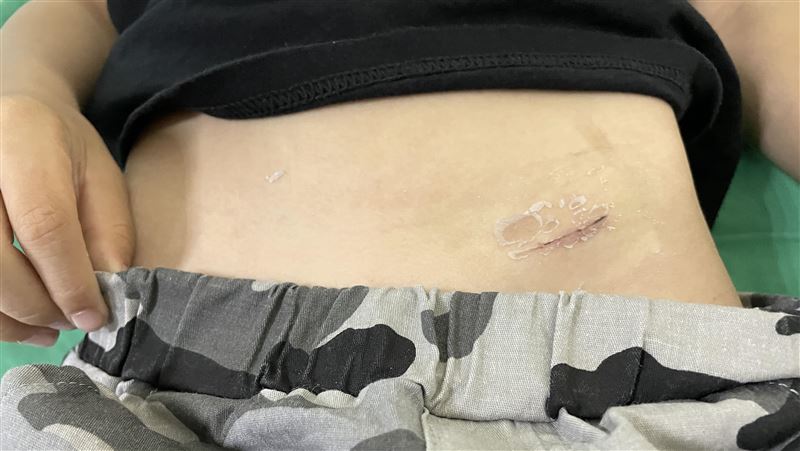 她腹股溝突腫一塊急就診！醫嘆：皮膚破了