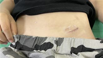 她腹股溝突腫一塊急就診！醫嘆：皮膚破了