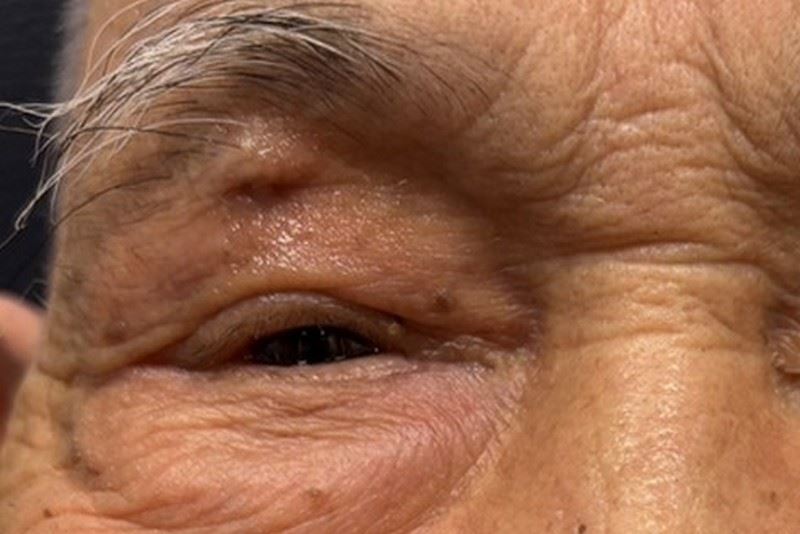 李爺爺因急性鼻竇炎眼周腫痛、影響視野；經鼻竇內視鏡及上眼皮引流手術後，順利恢復原貌。（圖／台北慈醫提供）