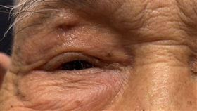 李爺爺因急性鼻竇炎眼周腫痛、影響視野；經鼻竇內視鏡及上眼皮引流手術後，順利恢復原貌。（圖／台北慈醫提供）