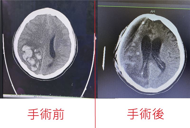 手術前腦中有大片高密度血塊，屬於腦內出血，外圍則有腦水腫，手術後移除大片血塊，順利替腦部解壓。(圖／烏日林新醫院提供)