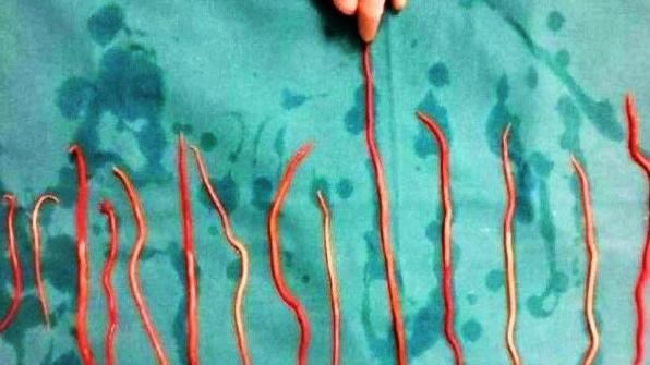 鼻爬出15cm蟲!印尼女童體內藏1kg蛔蟲