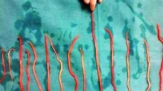 鼻爬出15cm蟲！印尼女童體內藏1kg蛔蟲