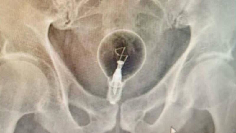 85歲阿公玩很大!「屁股塞燈泡」被送醫