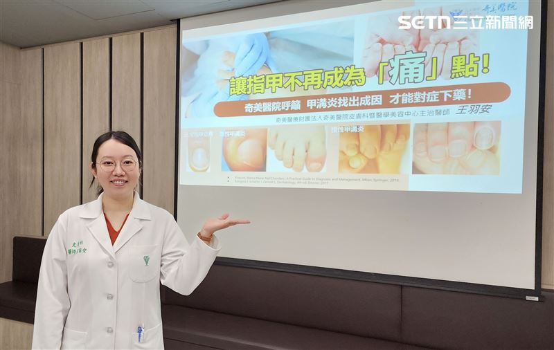 奇美醫院皮膚科暨醫學美容中心主治醫師王羽安說明,急性甲溝炎常因外傷、過度修剪指甲或咬指甲引起。(圖/奇美醫院提供)