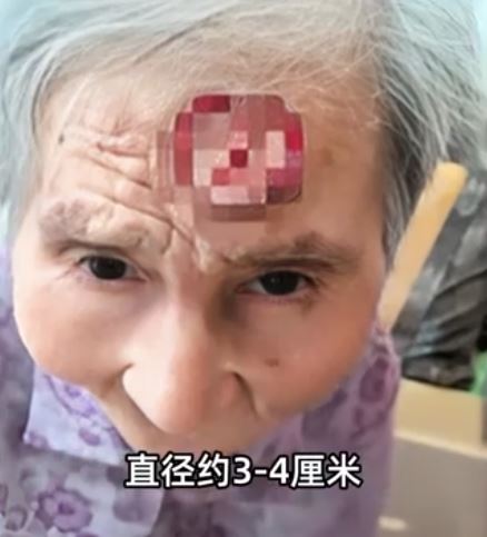 醫師解釋,長在老婦額頭上的「角」其實是皮膚病變,統稱為皮角,因為角質增生,為罹癌或是良性、惡性腫瘤的前兆,年長者為高風險族群。(圖/翻攝自微博)