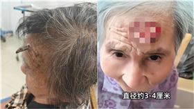 98歲老婦「額頭長角」自己剪掉！傷口秒膨脹險大出血　醫驚：差點救不回（圖／翻攝自微博）