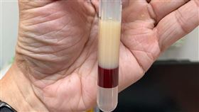 陳志金醫師貼出一張油血分離照，他說明，病人的三酸甘油酯是1677！而正常值應該要小於150。（圖／翻攝自陳志金臉書）