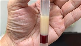 陳志金PO出高血脂病患的血液。（圖／Icu醫生陳志金臉書）