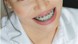 矯正牙少用2物清潔　拆牙套驚見8顆牙蛀壞