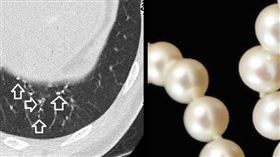 60歲男照斷層掃描驚見一串珍珠項鍊，醫師卻秒喊：「安啦！」（圖／翻攝自蘇一峰臉書）