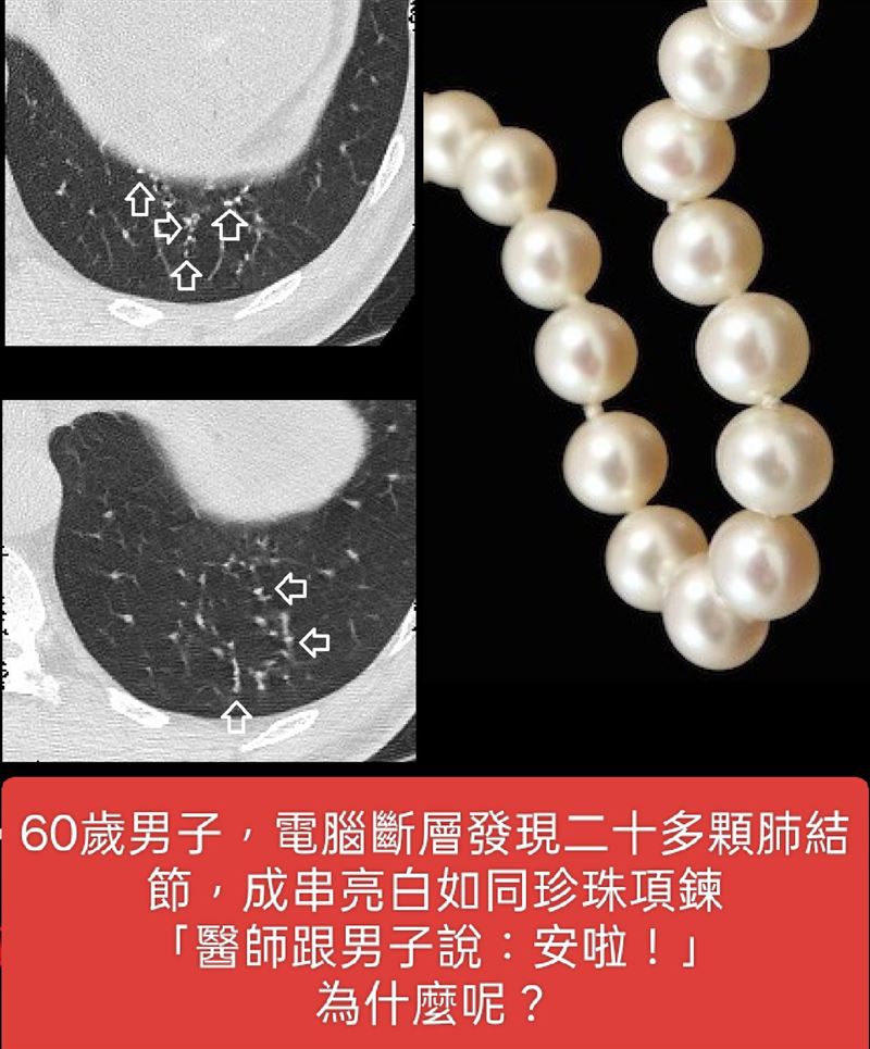 一名60歲男子照斷層掃描後，發現20多顆肺結節，宛如一串珍珠項鍊。（圖／翻攝自蘇一峰臉書）