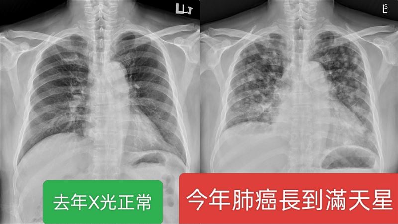 蘇一峰提醒，千萬不要覺得每年有定期照X光，就不會罹患肺癌。（圖／翻攝自蘇一峰臉書）