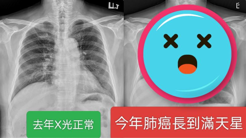 他每年X光都正常卻罹癌　醫驚：轉移了