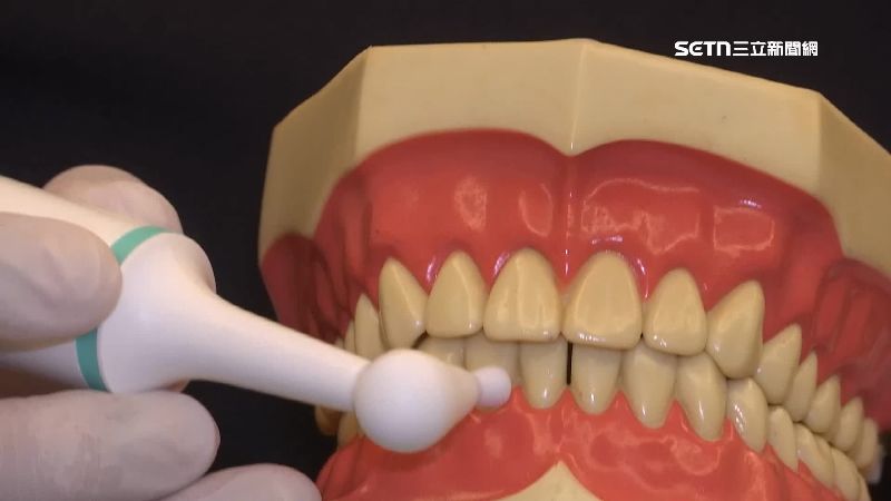獨／DIY磨牙　居家拋光恐傷牙齦、琺瑯質
