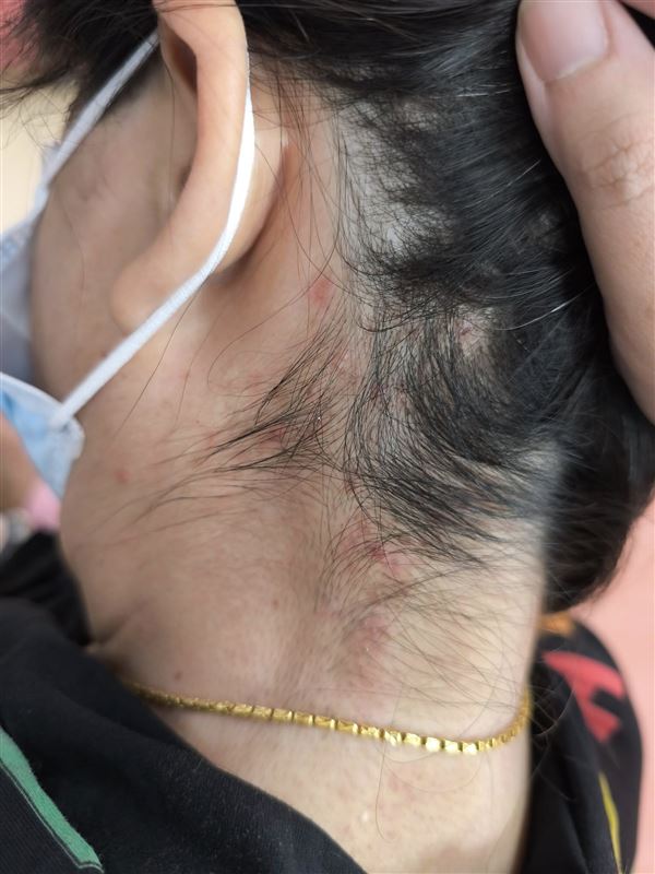 患者平日常到髮廊洗頭與造型，極可能因共用梳子遭到傳染。（圖／翻攝自皮膚專科 烏惟新醫師臉書）