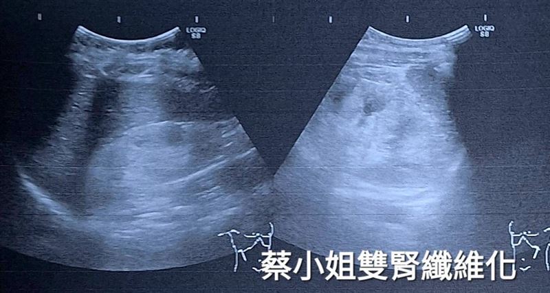 一名28歲女子,有糖尿病家族史,19歲確診糖尿病,後因飲食不節制,又未規律回診追蹤,雙腎嚴重萎縮。(圖/阮綜合醫院提供)