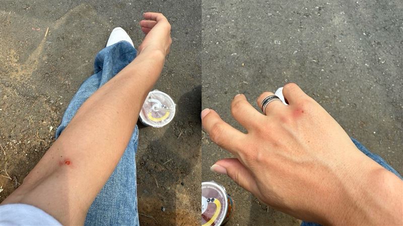 陳智菡曬出自己受傷的抓痕照。（組合圖／翻攝自陳智菡臉書）