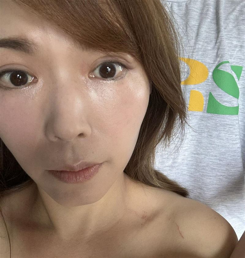 陳智菡曬出抓痕照，透露自己爬拒馬受傷。（圖／翻攝自陳智菡臉書）