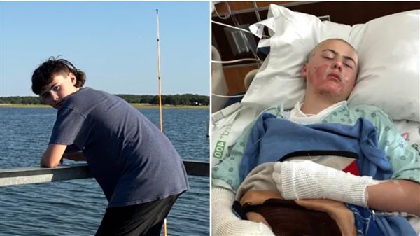 德州一位12歲少年，模仿TikTok影片導致臉、手臂紛紛等燒傷，他母親直呼「皮膚好像融化」。（圖／翻攝自GoFundMe）