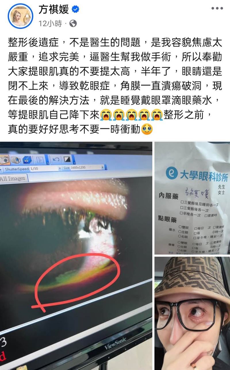 雪碧去年曾在社群分享整形的後遺症，強迫醫生替她手術，結果提眼肌提太高導致睡覺眼睛閉不起來。（圖／翻攝自雪碧臉書）