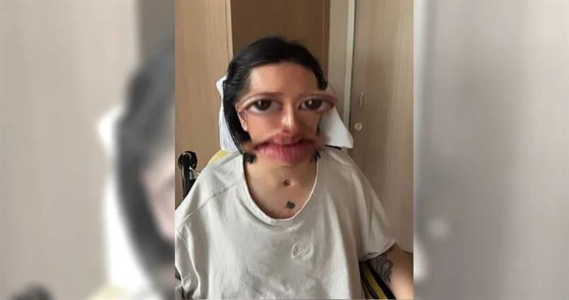 阿Mo於7月時曬出正面照，頸部下方清楚可見插管的傷口。（圖／翻攝自Instagram／momo.lky）
