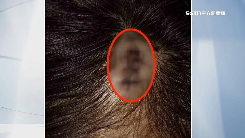 吳姓老翁拿棍攻擊，麵攤老闆娘滿頭血，縫了好幾針