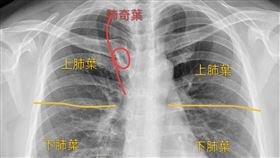 病人照X光後，發現肺部多了一個肺奇葉。（圖／翻攝自蘇一峰臉書）
