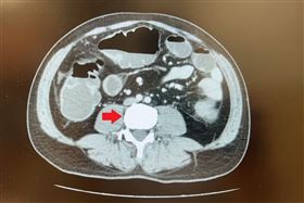 電腦斷層檢查看到降結腸處有一顆5公分的大腫瘤造成腸阻塞。（圖／台北慈濟醫院提供） 