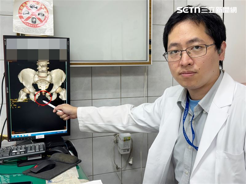 醫師表示當時病患到院時，骨盆幾乎爆開，直腸破裂外露、膀胱也破裂，患部血肉模糊，大量失血休克，緊急送往李綜合醫院苑裡院區開刀治療（圖／翻攝畫面）