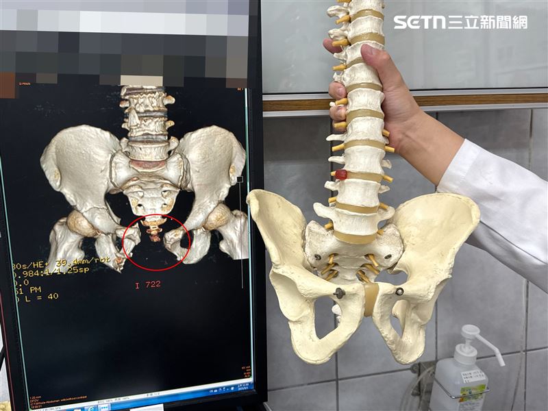 在醫師團隊的合作下花了4個多小時，幫患者進行剖腹探查術、D環結腸造口術、會陰肌皮瓣重建術、膀胱一期修復術、骨盆開書型骨折切開復位外固定術，終於從鬼門關搶救成功。（圖／翻攝畫面）