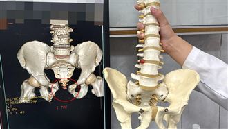 沙袋重砸男失血1/3且骨盆爆　醫4小時搶命