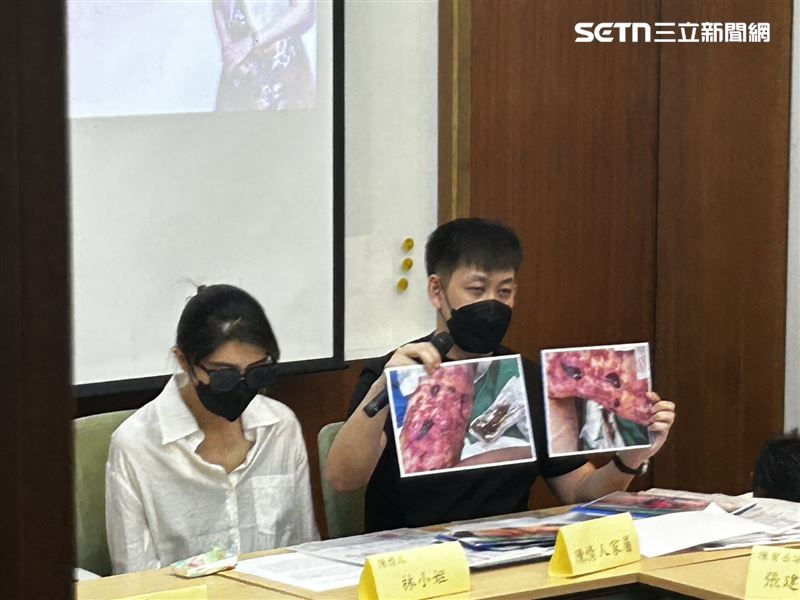 林小姐丈夫（右）展示妻子術後雙腿留下大面積疤痕、腳趾壞死需反覆治療。（圖／記者簡浩正攝影）