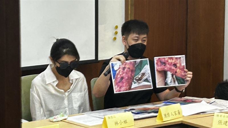 她抽脂「險死」得洗腎！醫師竟甩鍋麻醉師