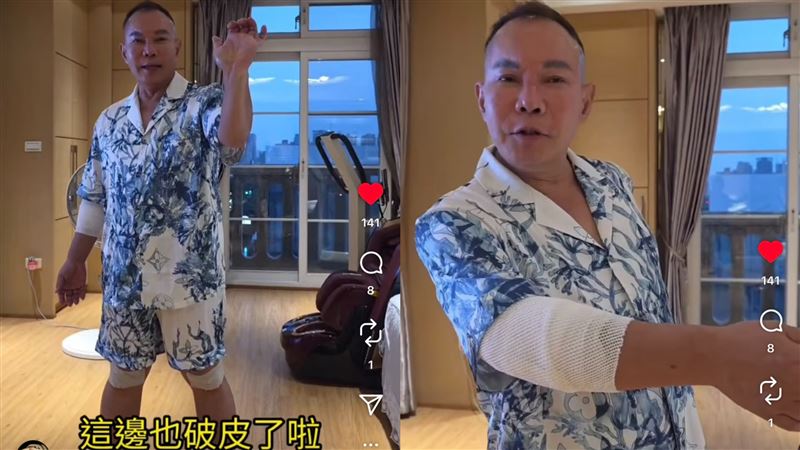 胡漢龑玩遊戲意外受傷,導致骨頭裂掉,手肘打石膏勇用綁帶固定,雙膝及手腕都破皮。(圖/翻攝自胡漢龑IG)