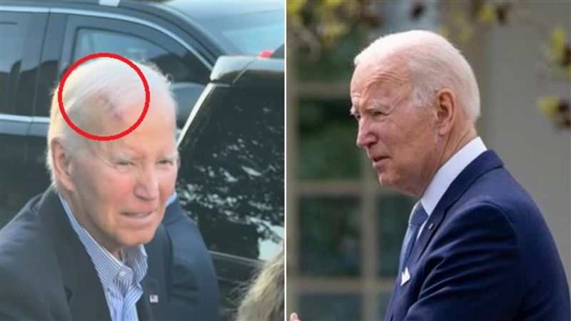 拜登頭部有傷！發言人曝：動過皮膚癌手術