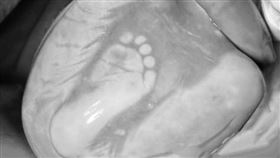 胎兒全身被羊膜包覆，只露出小腳丫，且周圍佈滿濃濃的胎便。 （圖／翻攝自施景中臉書）