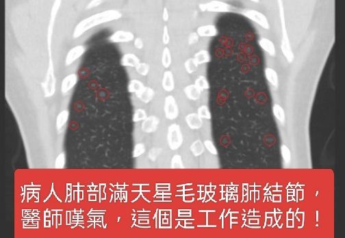 一名60歲女子經檢查發現，肺部有數十顆毛玻璃肺結節。(圖／取自蘇一峰的臉書)