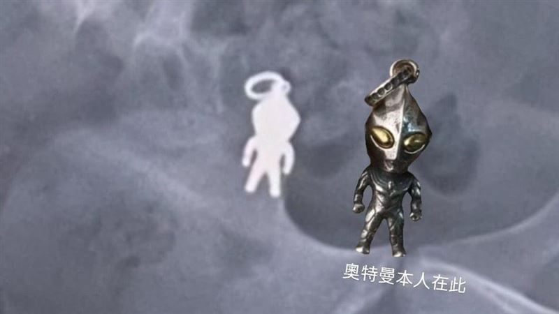 8歲童誤吞「超人力霸王」醫：器官恐穿孔