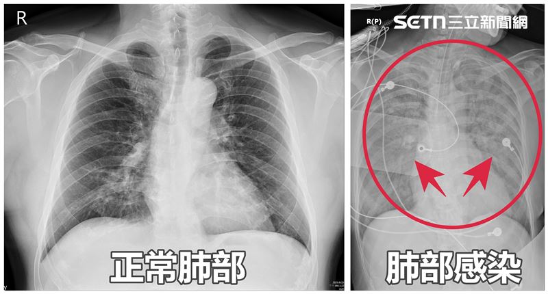 老闆娘嗜睡、胃口差　醫一照：雙肺全白
