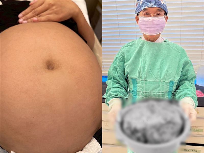 洗臉盆裝竟然裝得下！新北一位林太太肚子大如懷胎10月，一檢查赫然竟是比西瓜大卵巢巨瘤。（圖／愛麗生婦產科診所提供）