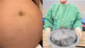 洗臉盆裝竟然裝得下！新北一位林太太肚子大如懷胎10月，一檢查赫然竟是比西瓜大卵巢巨瘤。（圖／愛麗生婦產科診所提供） 