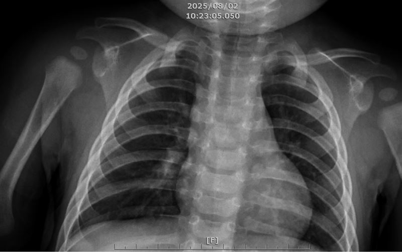9月童曾施打疫苗，有基本防護力，經過10天抗生素治療無併發症健康出院。(圖／臺中醫院提供)