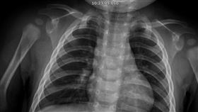 9月童發高燒39度， 竟染「大魔王」肺炎鏈球菌(圖／臺中醫院提供)