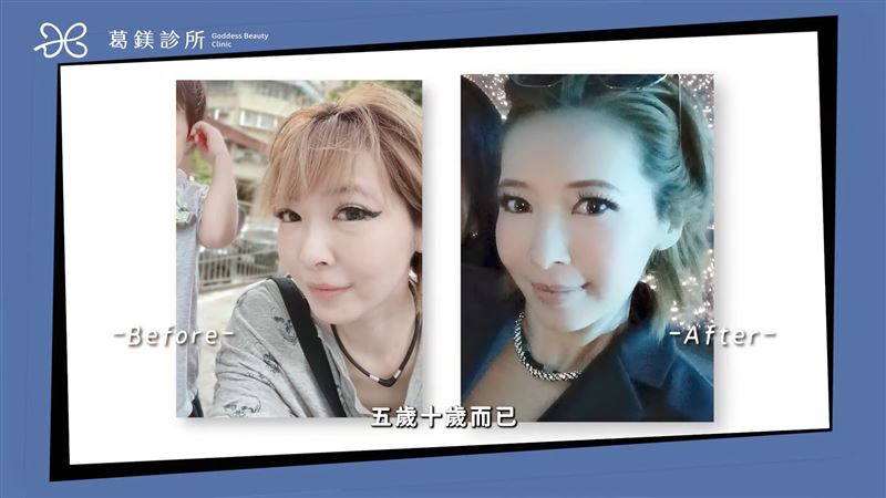 Makiyo手術前後差異甚大。（圖／翻攝自葛鎂醫學美容診所YouTube）